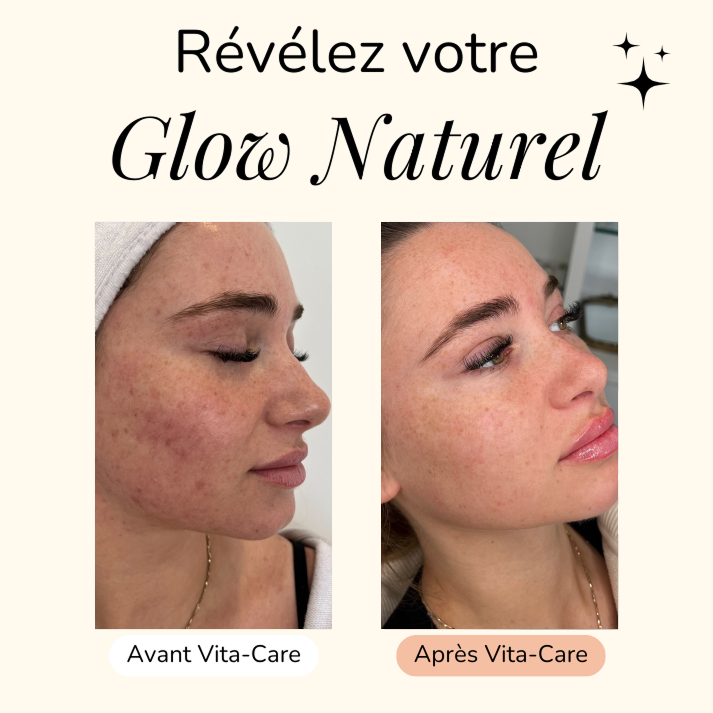 Masque anti-taches au Curcuma