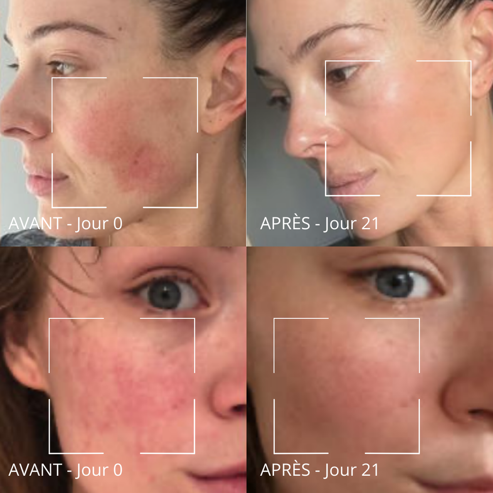 Masque anti-rougeurs Rose & Vitamine C