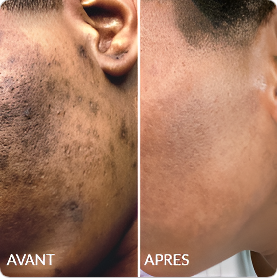 Avant / Après de Wisseme D.