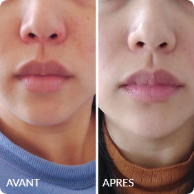 Avant / Après de Valentine D.
